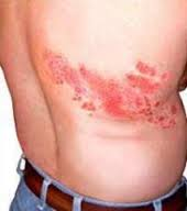 Eruzione cutanea caratteristica dell’Herpes Zoster con localizzazione toracica