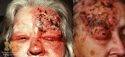 Herpes Zoster oftalmico con uveite e cheratite